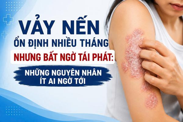 Vảy nến đã ổn định nhiều tháng nhưng bất ngờ tái phát: Những nguyên nhân ít ai ngờ tới