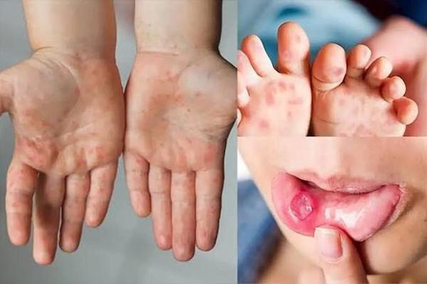 Trên 3.000 ca tay chân miệng mỗi tuần, nguy cơ gia tăng khi trẻ vào năm học mới