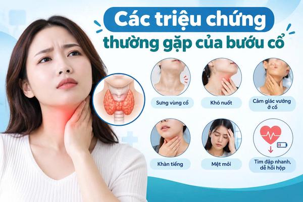Các triệu chứng thường gặp của bướu cổ